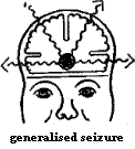 generalised seizure