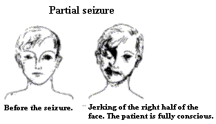 partial seizure