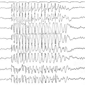 EEG during an Absence